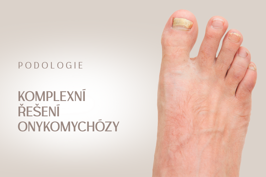 Komlexní řešení onychomykózy – plíseň