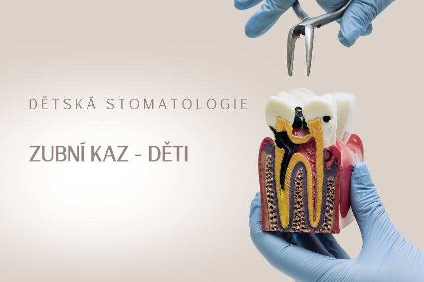 Zubní kaz