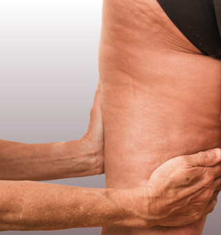 Blog-lecba Lipedemu - 320x340